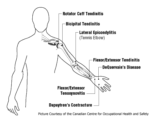 Types of Tendinitis